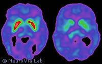 L'IRM de diffusion : surveiller les tumeurs du cerveau