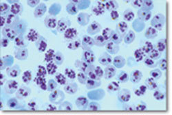 Globules rouges infectés par le parasite responsable du paludisme.