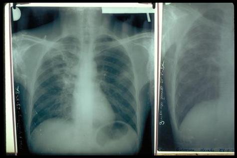 Poumons de patient atteint de tuberculose.