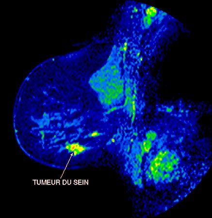 Image couleur d'un cancer du sein (perso.wanadoo.fr/association.afrha/icono.htm)