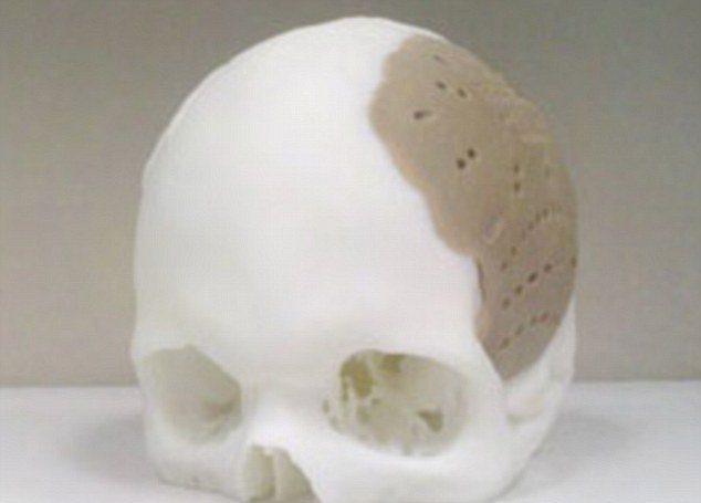 L'implant crânien imprimé en 3D pourrait devenir de moins en moins rare. Surtout si 500 patients en bénéficient chaque mois aux&nbsp;États-Unis.&nbsp;© Oxford Medical Performances