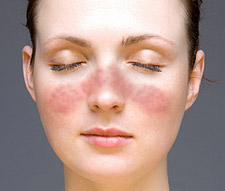 Le lupus est une maladie auto-immune qui provoque l'apparition d'un érythème facial en forme de papillon. © NIH, Wikimedia, domaine public
