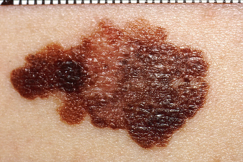 Les mélanomes forment des taches noires sur la peau. Wikimedia Commons