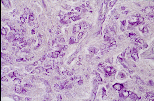 Neuroblastome du cervelet observé en microscopie optique. © Anocef