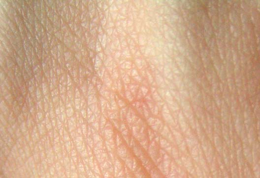 La peau peut être atteinte par de nombreuses maladies, dont l'ichtyose. © Wikimedia Commons