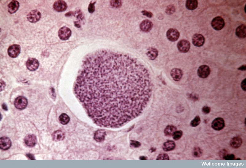 Plasmodium vivax, ici au milieu de cellules hépatiques, est responsable de plus de 100 millions de cas de paludisme à travers le monde chaque année, et épargnait jusque-là l'Afrique subsaharienne. Mais une duplication génique pourrait changer la donne... © Wellcome Library, Wellcome Images, cc by nc nd 2.0
