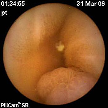 Polype hamartomateux de type Peutz-Jeghers au niveau de l'intestin grêle révélé par vidéo-capsule. Crédit CHRU de Lille (France).