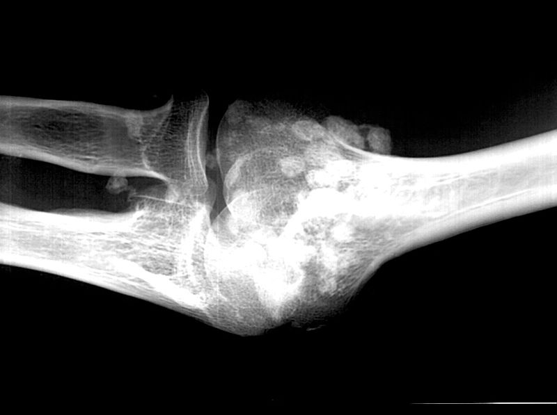 Grâce à la radiologie, on peut réaliser des images radiographiques, comme ici de l'articulation du coude. © NatFolk34, Wikipédia, cc by sa 2.5