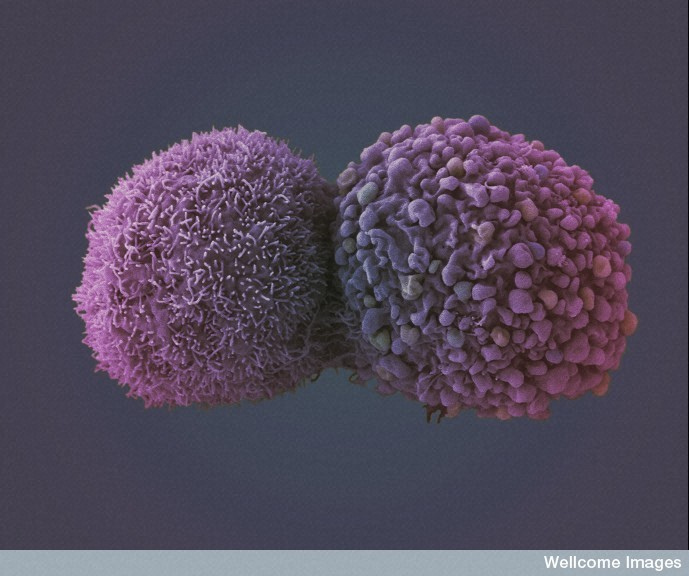 Le cancer se caractérise par la multiplication incontrôlée de cellules, qui aboutit à la formation d'une masse appelée tumeur. C'est l'objet d'étude de l'oncologie. © Anne Weston, Wellcome Images, cc by nc nd 2.0