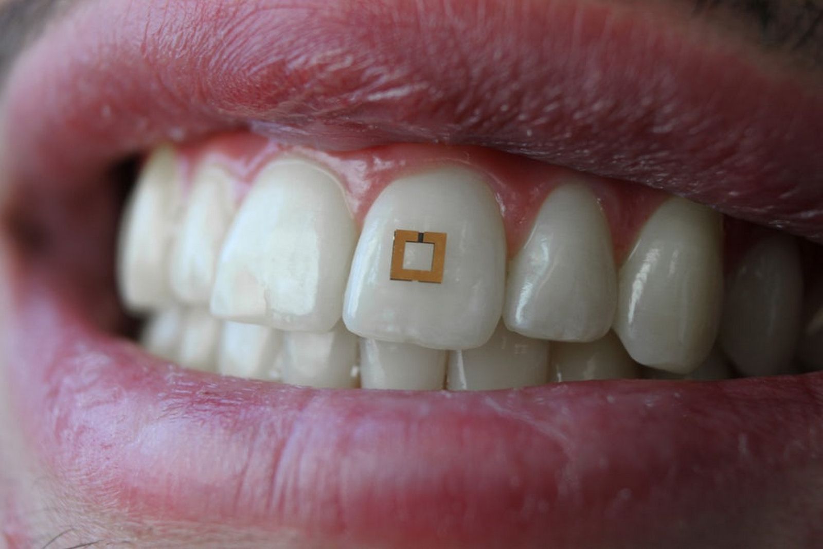 Le capteur dentaire est composé de trois couches et fonctionne comme une étiquette électronique. © SilkLab, Tufts University