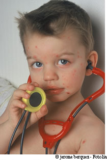 La varicelle peut être dangereuse pour les adultes. La vaccination divise les risques par neuf. © Jérôme Berquez/Fotolia
