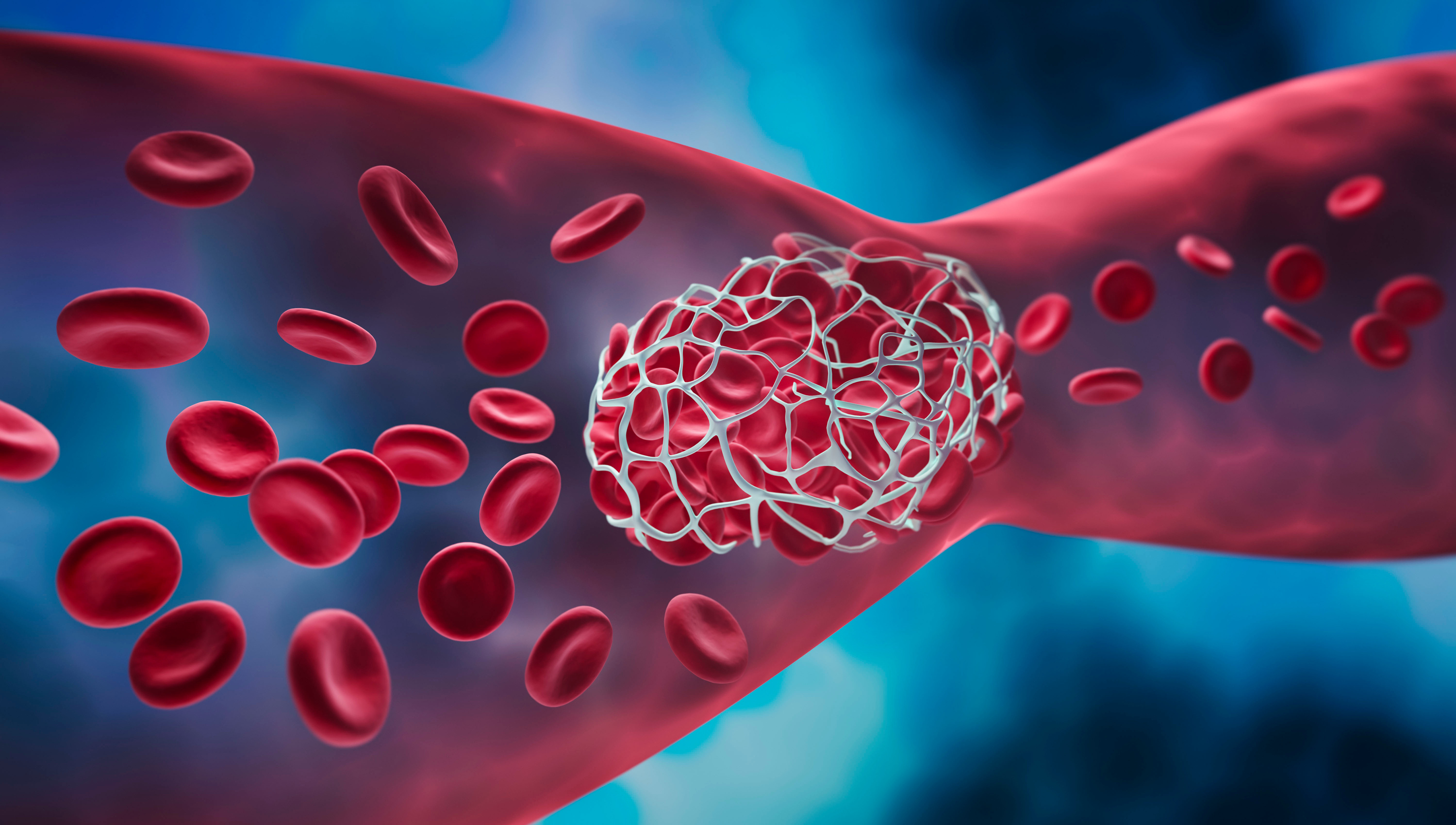 Caillot sanguin bloquant un vaisseau sanguin. © peterschreiber, Adobe Stock 