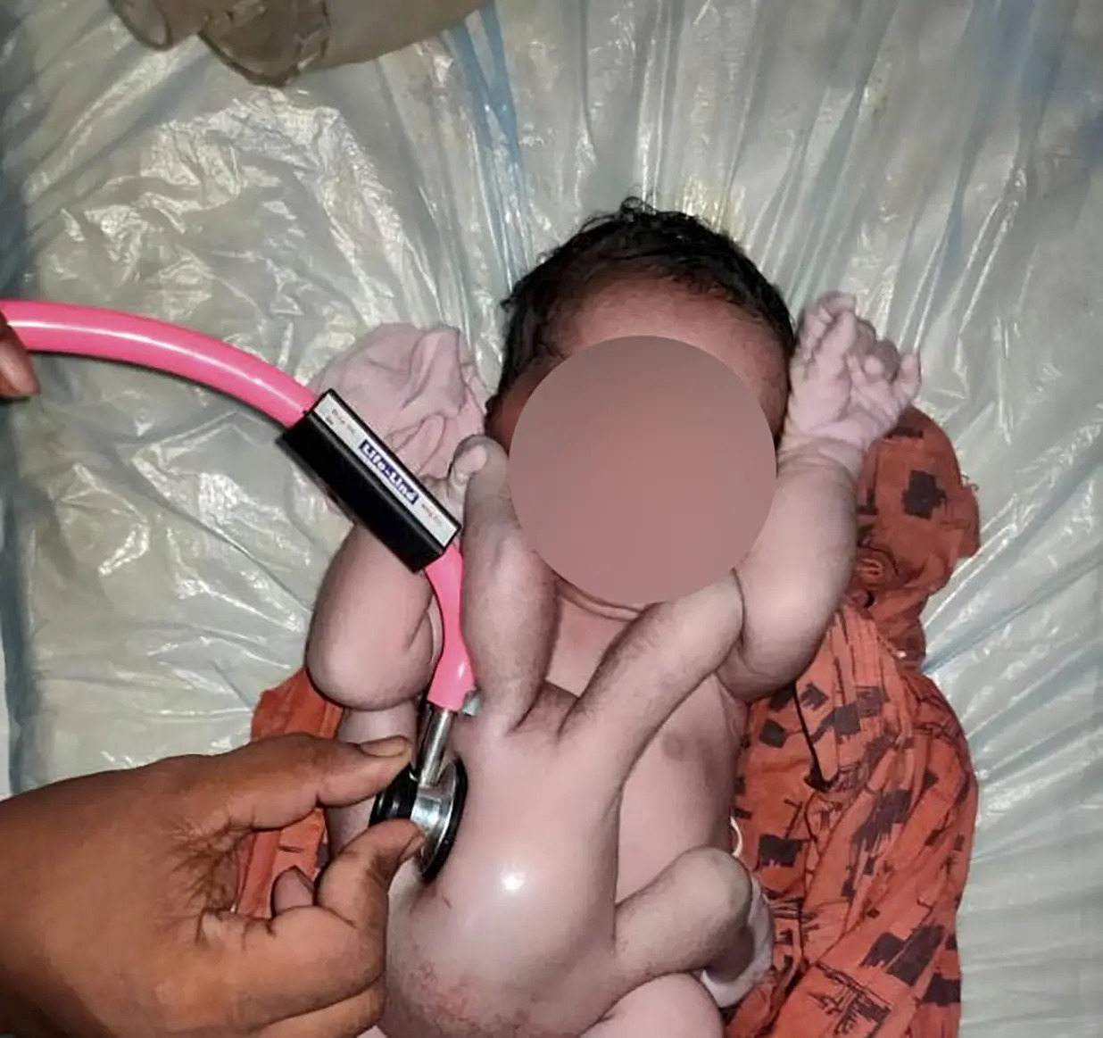 Le bébé né en Inde avec des membres supplémentaires. © Newslions, SWNS