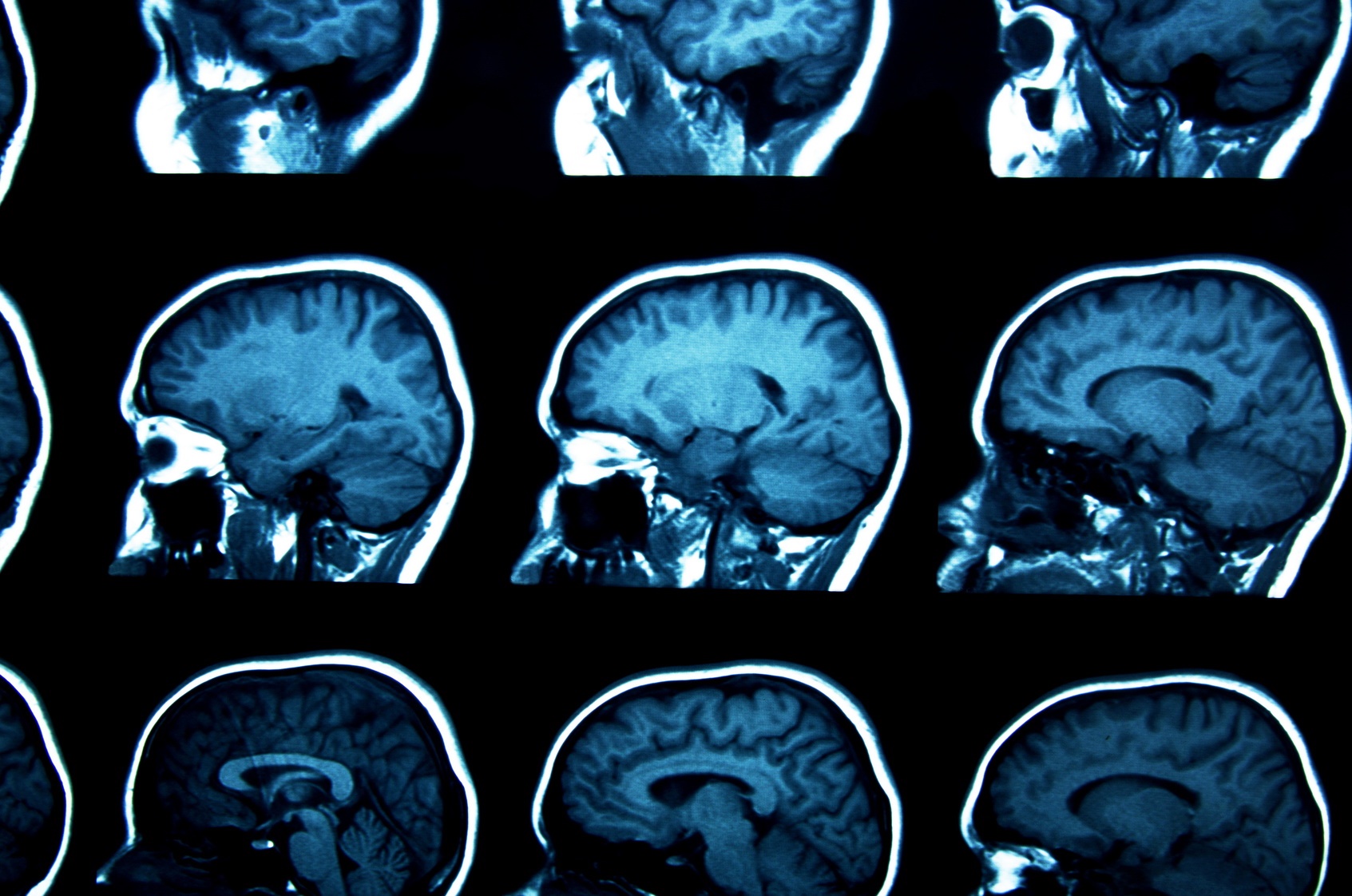 Le cancer du cerveau peut être détecté par IRM. © gmstockstudio, Fotolia