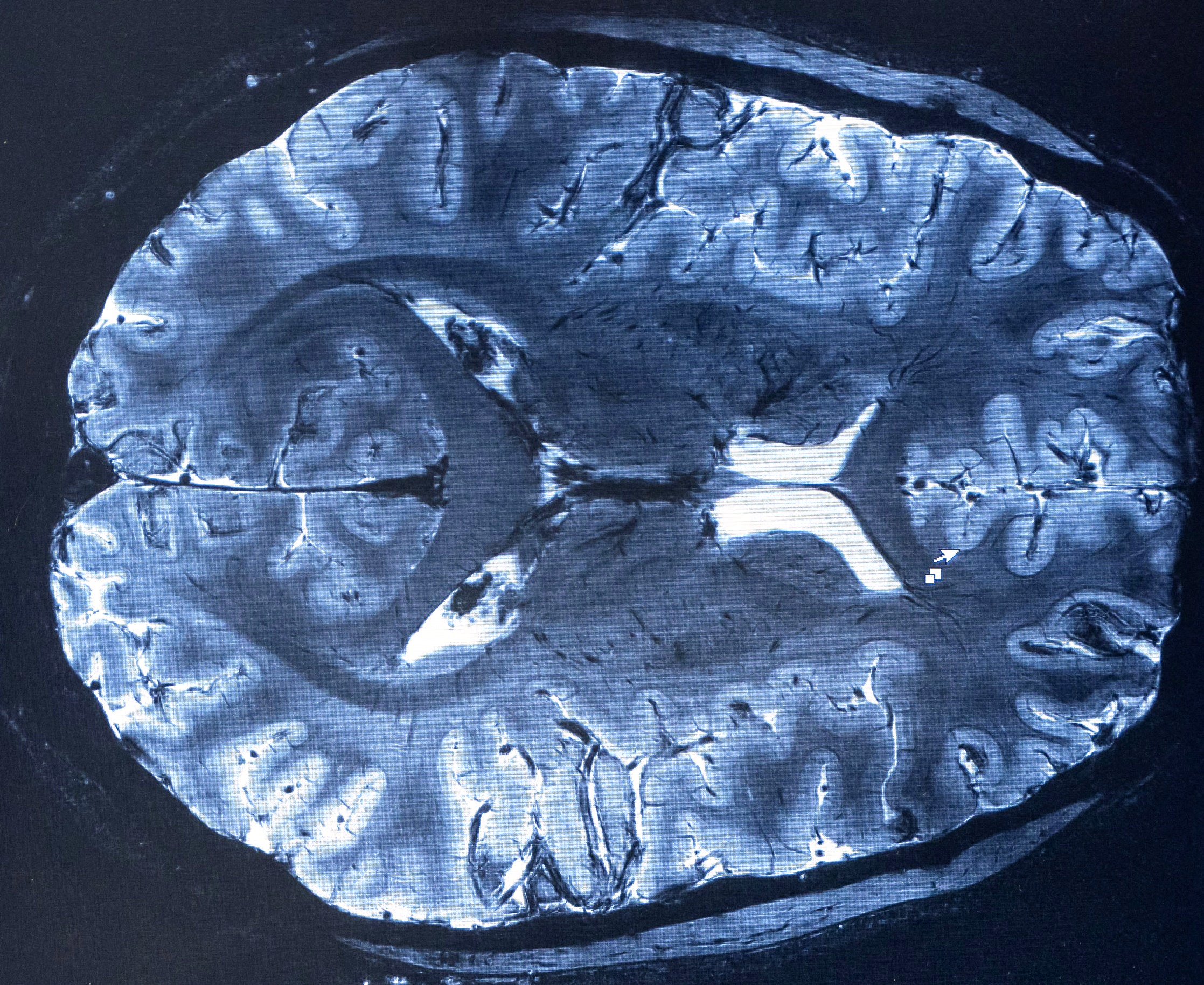 Le CEA obtient les images par IRM du cerveau les plus précises au ...