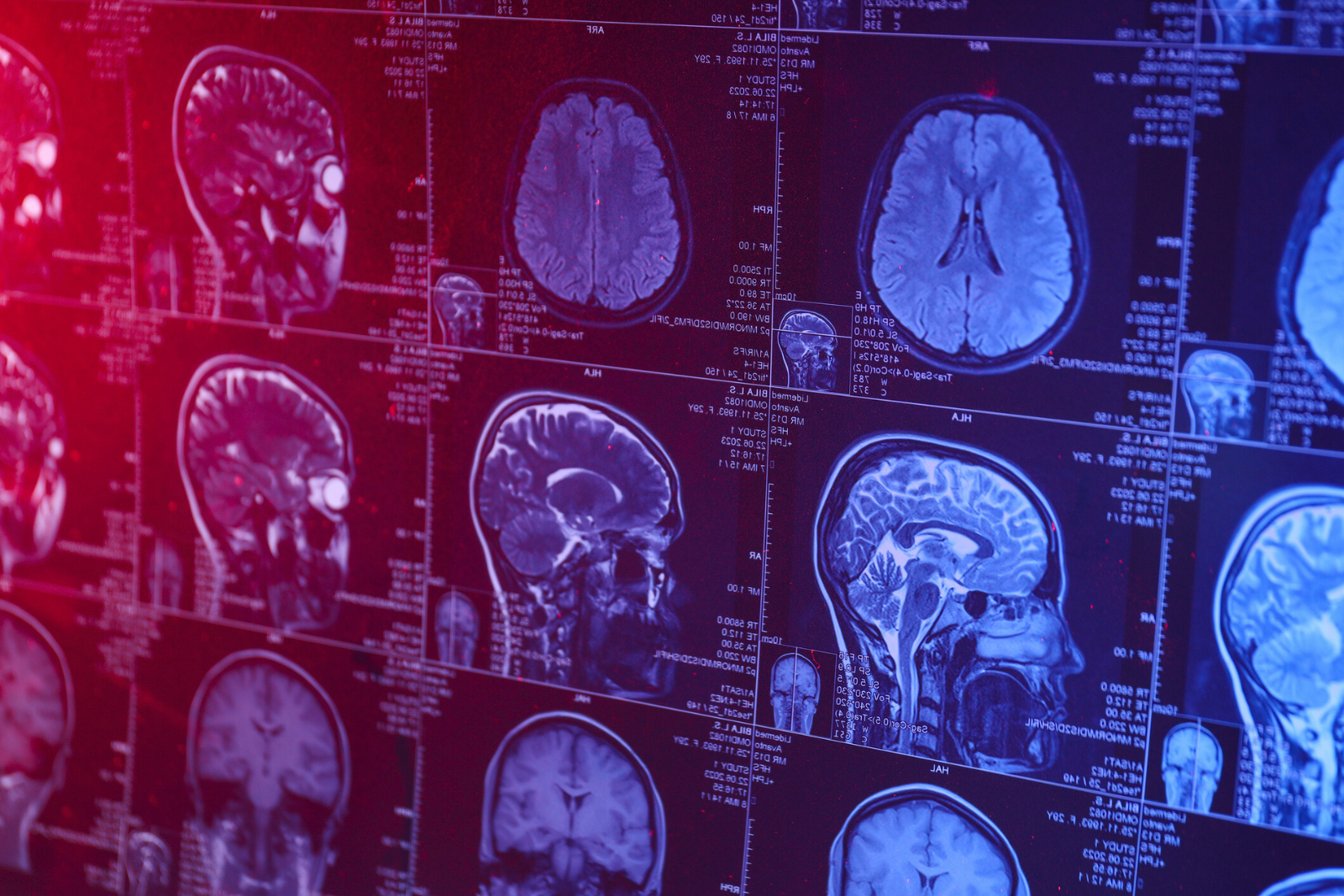 Les scientifiques diagnostiquent le plus jeune cas d'Alzheimer jamais enregistré. © Lillia Bila, iStock