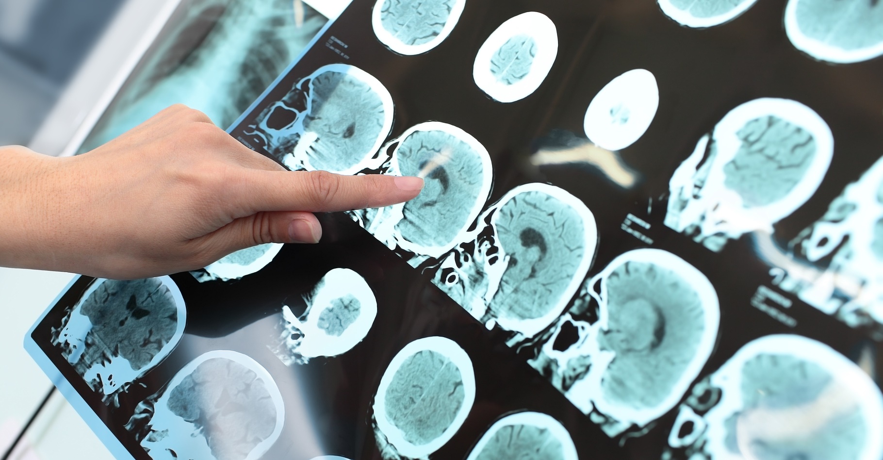 La maladie d’Alzheimer est liée à la présence de dépôts amyloïdes dans le cerveau. L’anticorps testé permet de les éliminer. © sfam_photo, Shutterstock