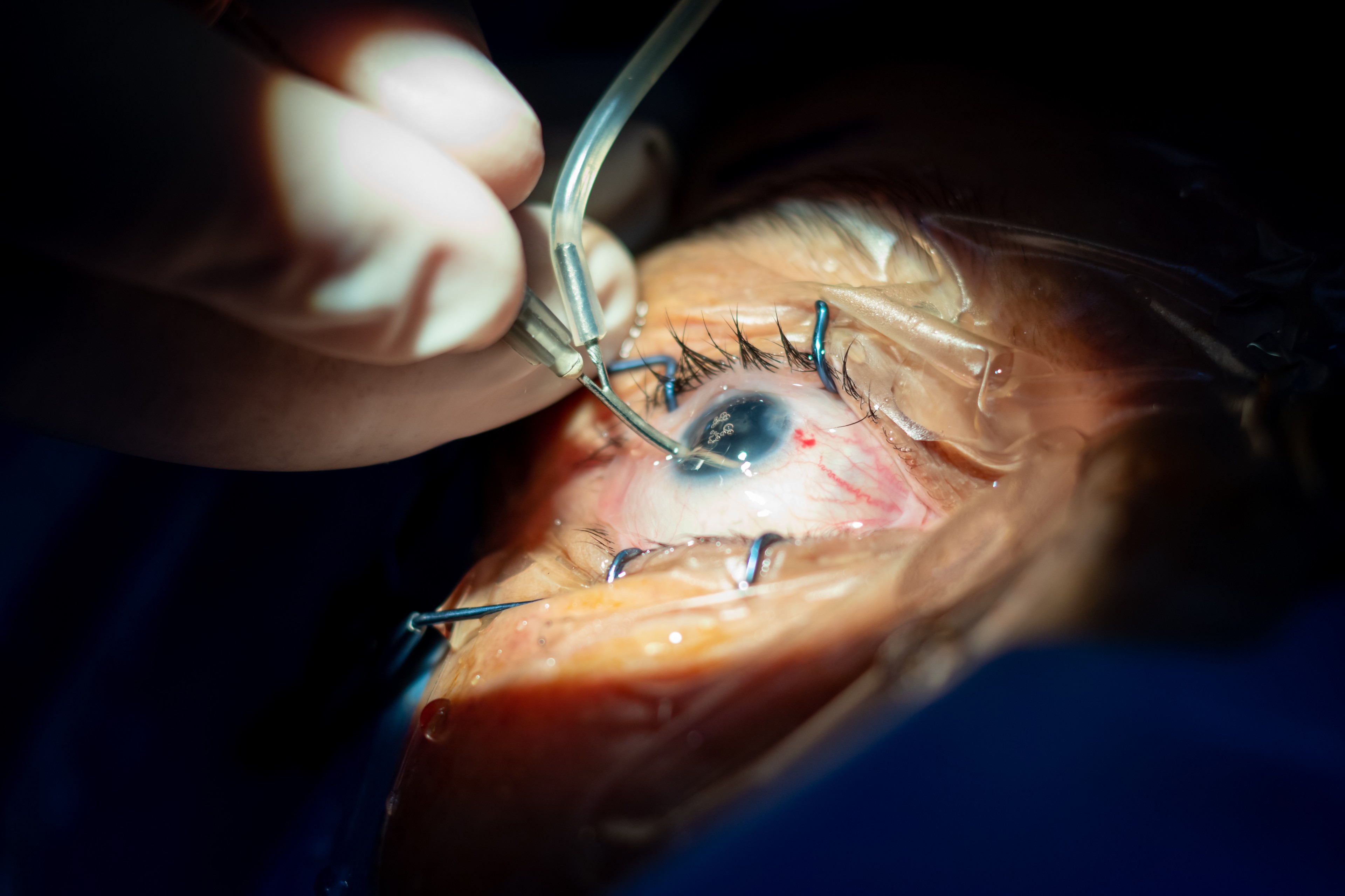 Une opération chirurgicale peut être nécessaire pour soigner les complications causées par un tatouage des yeux. © Mostafa Eissa, Adobe Stock