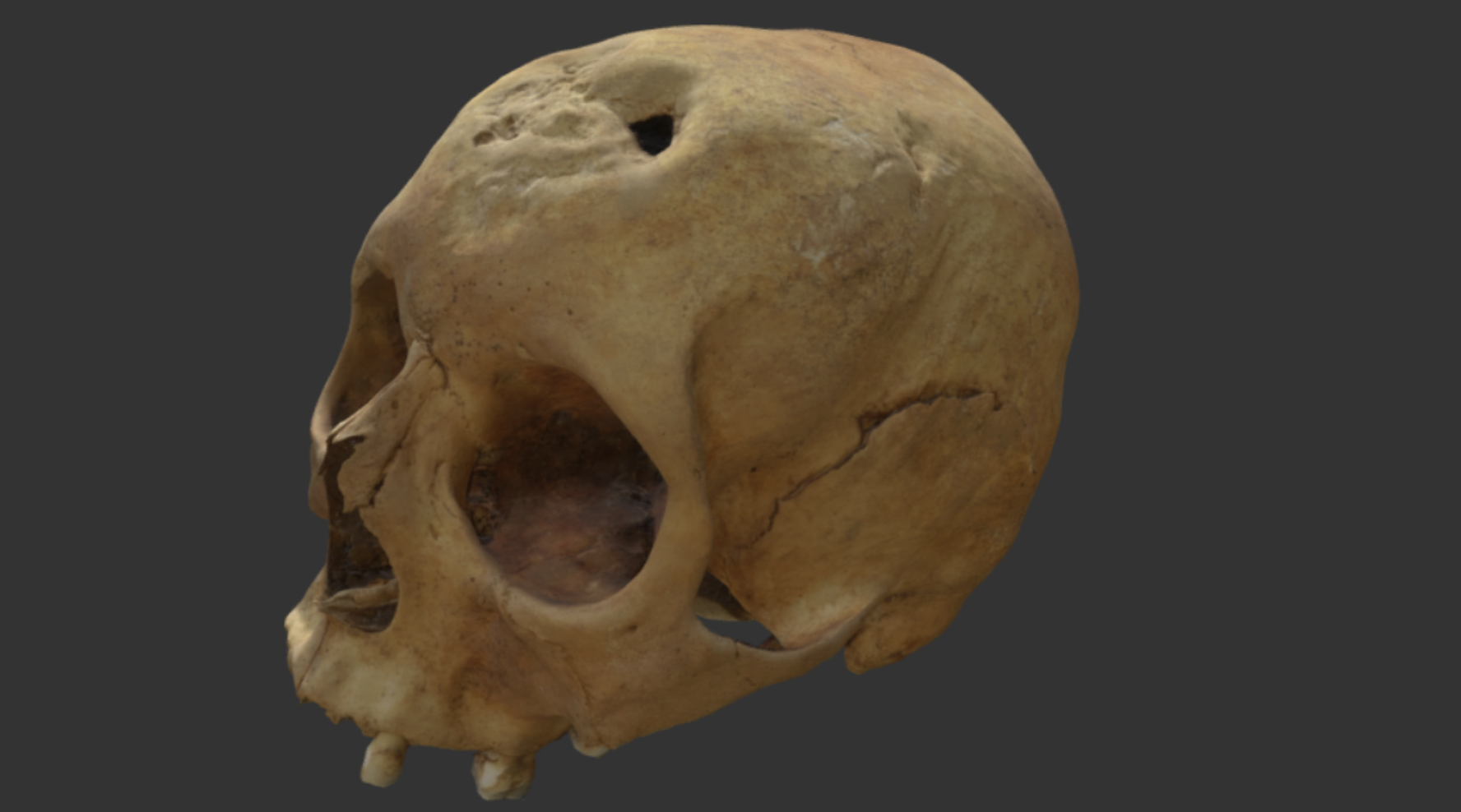 Lors d'une fouille archéologique en Islande, un crâne a révélé des traces de la syphilis.&nbsp;© Sketchfab, Creative Commons license, CC0, domaine public