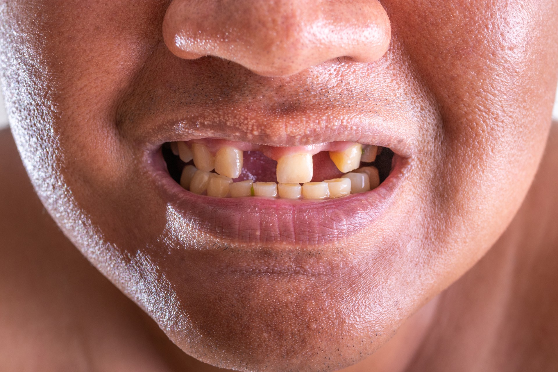 L'agénésie dentaire est une maladie où une ou plusieurs dents définitives sont absentes. © praewpailyn, Adobe Stock