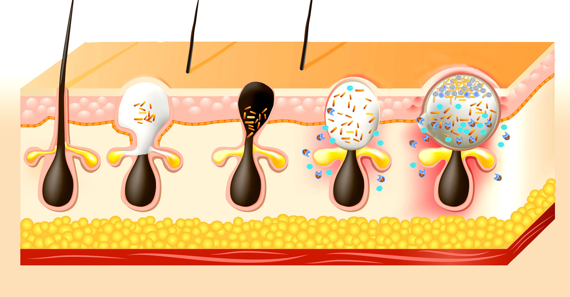 Les mécanismes de l'acné