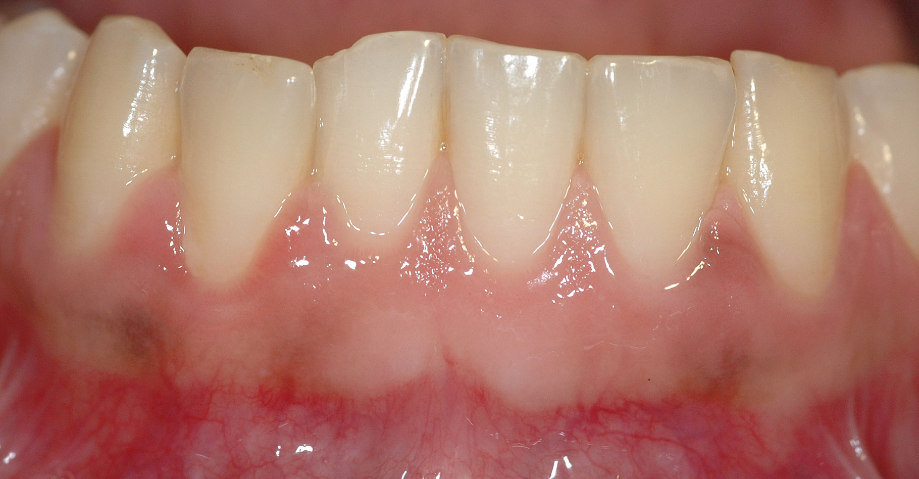 Gingivite et poche parodontale : des maladies parodontales répandues