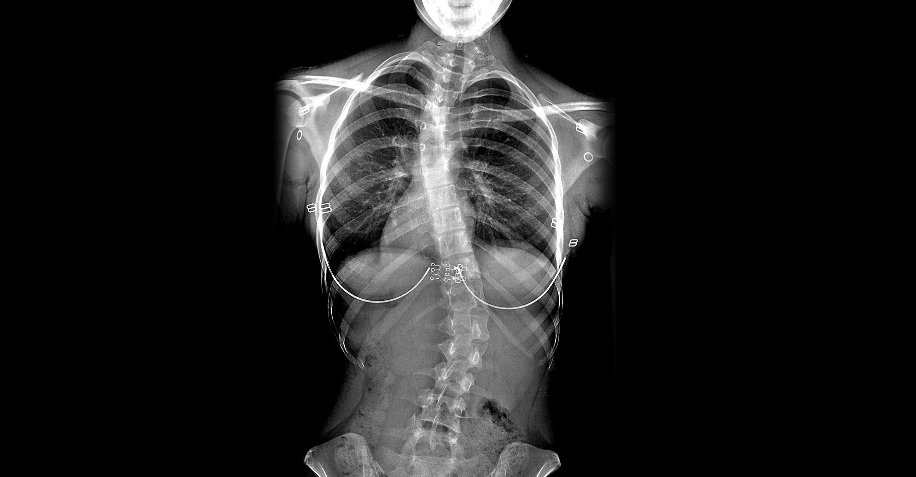 Scoliose d'une jeune fille de 16 ans. © University of Utah Hospital, Domaine public