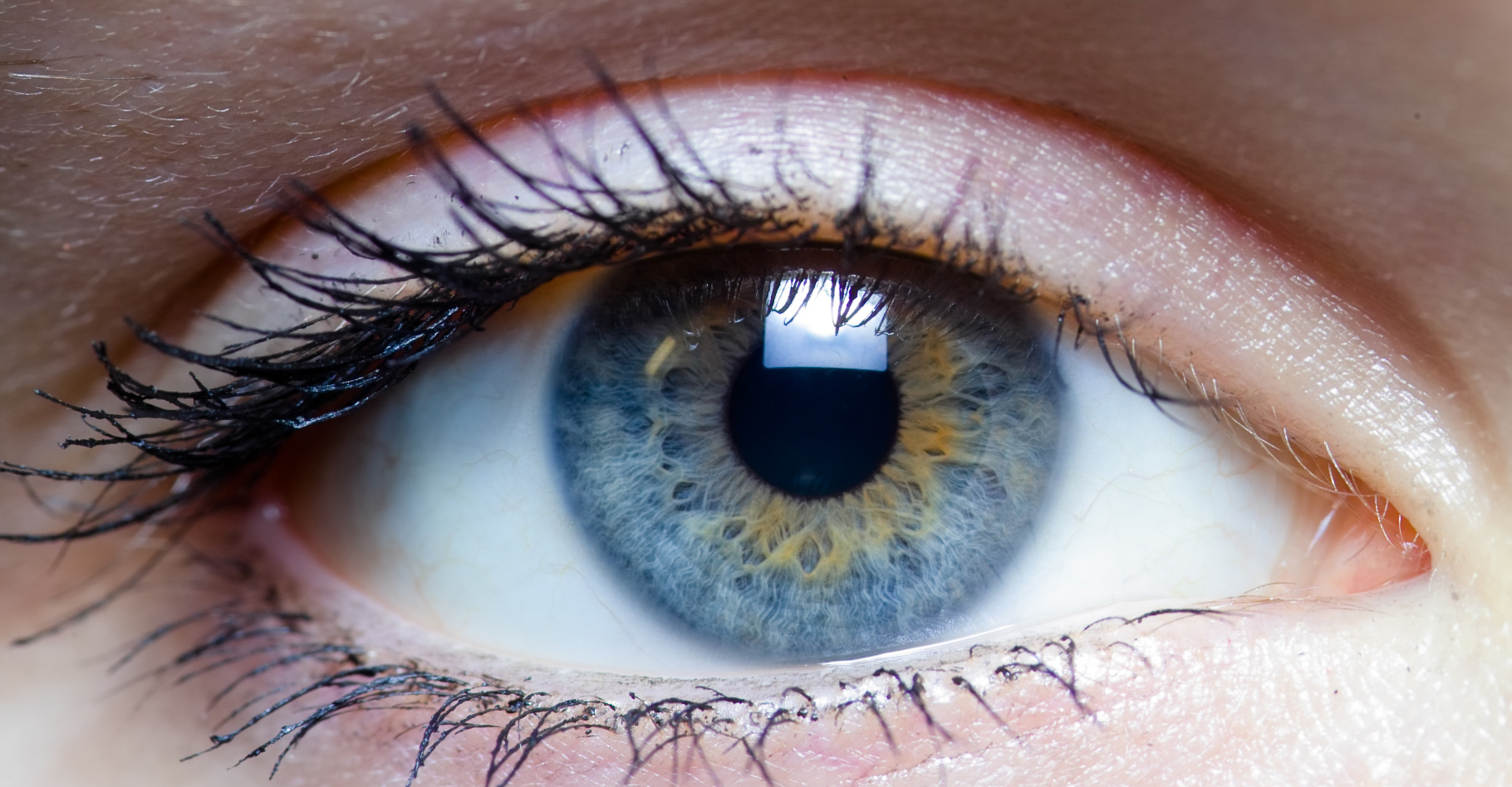 La cataracte entraîne une baisse de la vue voire la cécité. © Laitr Keiows, Wikimedia commons, CC by-nc 3.0