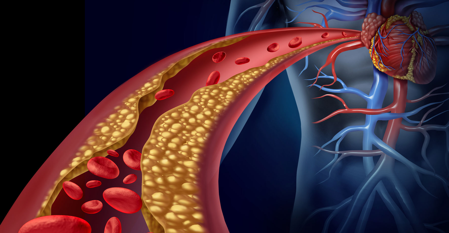 Taux de cholestérol : hypercholestérolémie et conséquences