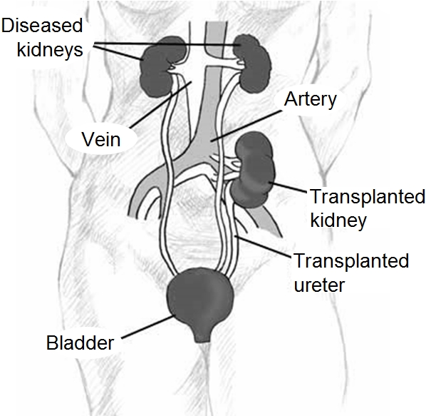La greffe de rein ou transplantation rénale