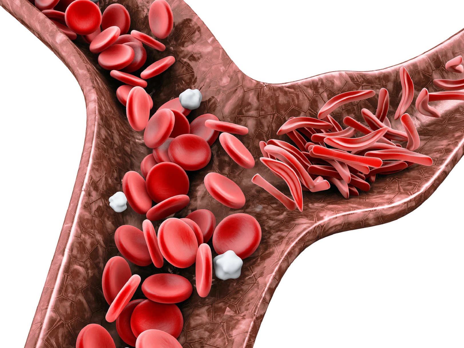 Dans la drépanocytose, les hématies (globules rouges) peuvent prendre une forme en faucille. © tussik, Fotolia