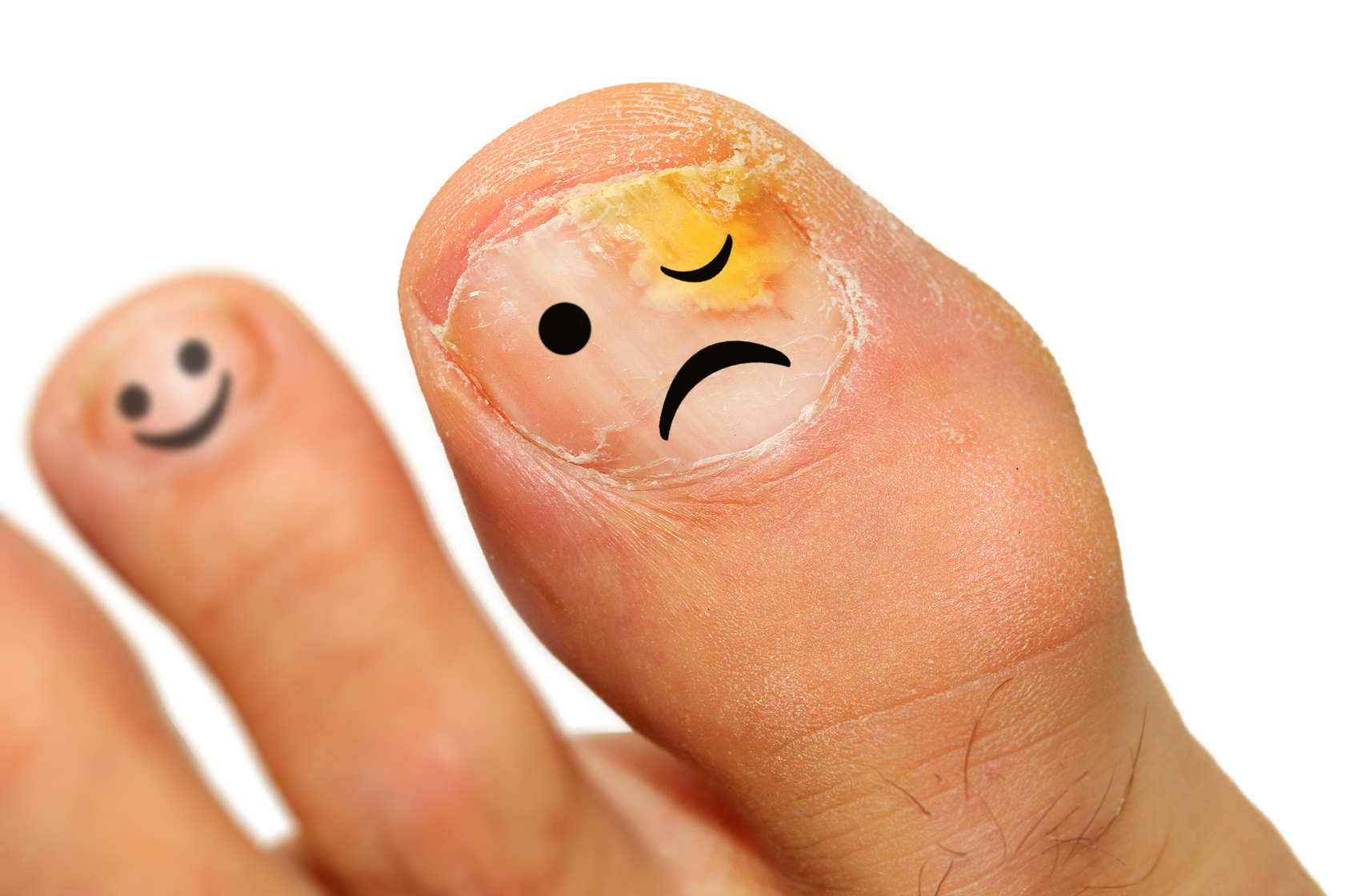 L’onychomycose est une mycose de l’ongle qui touche le plus souvent les pieds. © Kletr, Fotolia