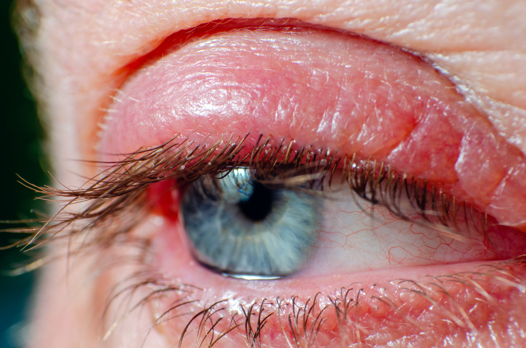 La blépharite est une inflammation de la paupière. © andrei310, Adobe Stock