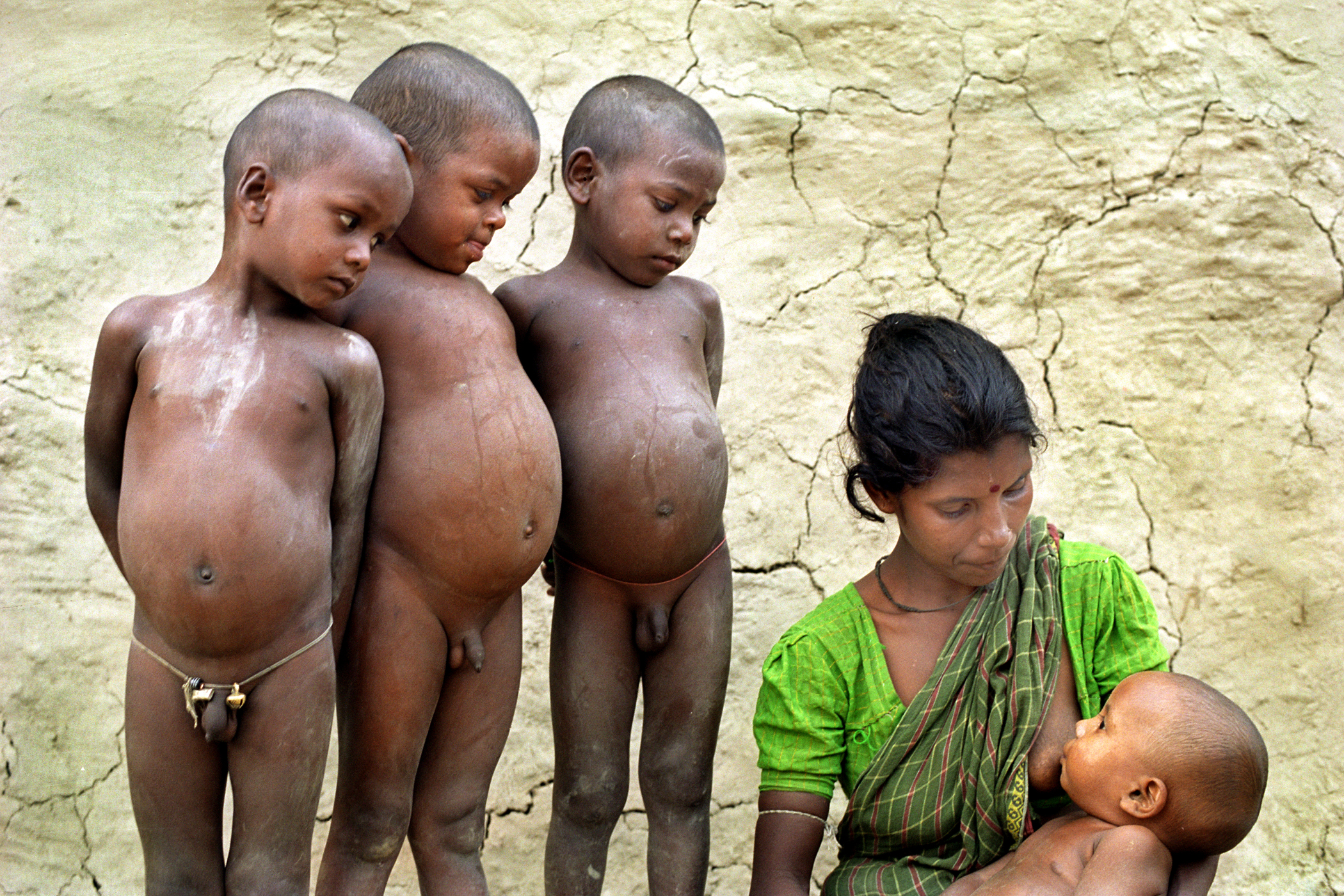 Le kwashiorkor est une grave carence en protéines qui touche principalement les enfants dans les pays en développement. © Nimai Chandra Ghosh, Flickr