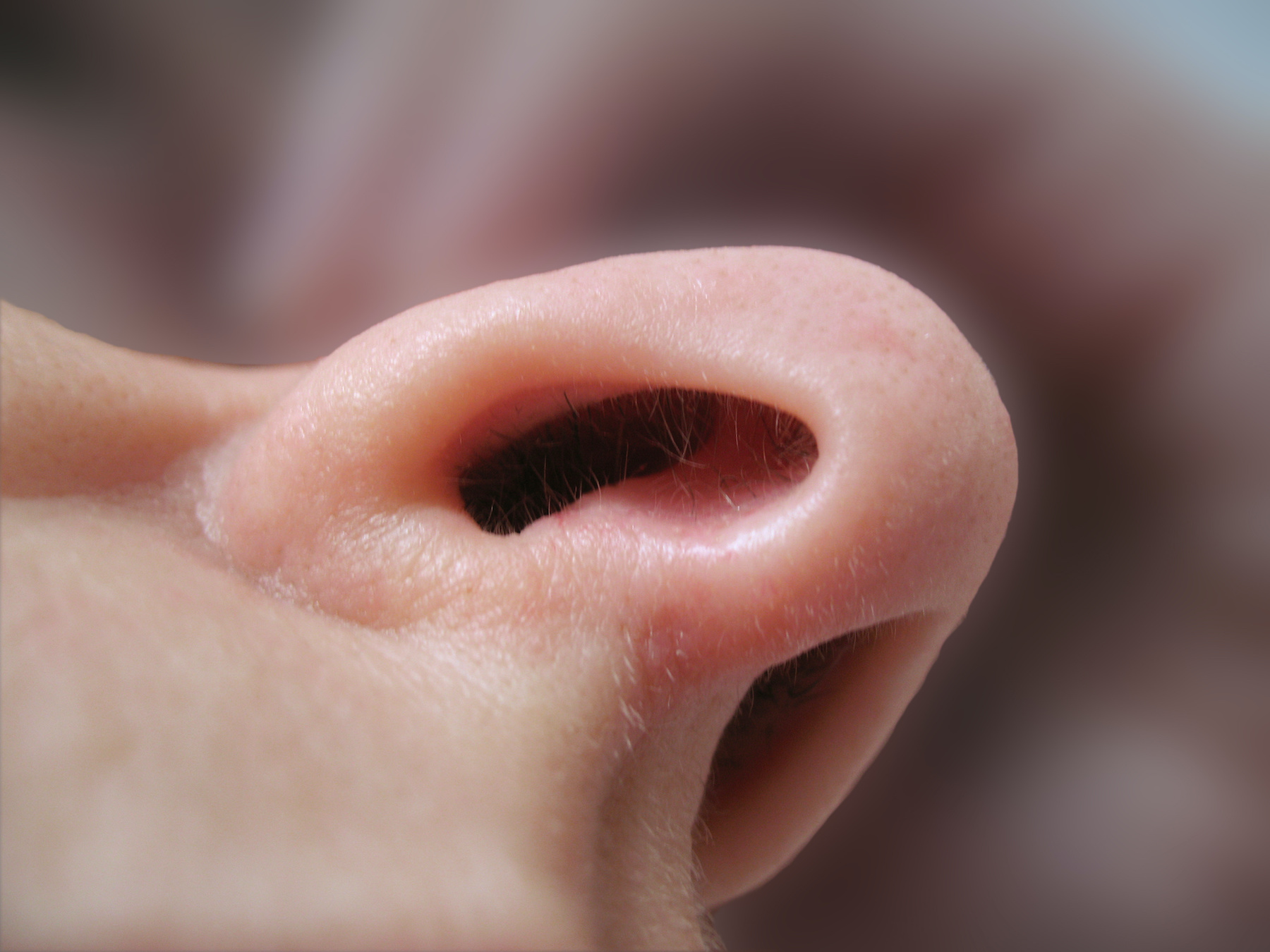 La polypose nasale est une inflammation chronique des muqueuses nasales et du sinus. © hans12, Adobe Stock