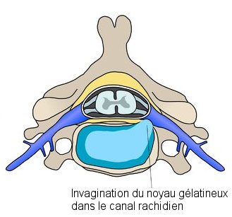 Schéma d'une hernie discale. Comme dans toute hernie, un organe fait saillie dans un autre. Ici, c'est le noyau gélatineux contenu dans le disque intervertébral qui s'invagine dans le canal rachidien (qui contient la moelle épinière). Cette intrusion peut provoquer une douleur locale (lombalgie par exemple) ou diffuse quand elle vient comprimer la racine d'un nerf (sciatique par exemple). © Debivort, cc