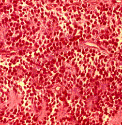 Coupe histologique d'un neuroblastome, vue au microscope optique, montrant les cellules rondes de la tumeur. © Docteur Dominique Plantaz