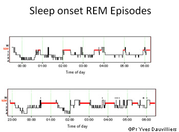 L’enregistrement polysomnographique du sommeil permet notamment de déterminer les cycles du sommeil et ses différentes phases. © Pr Yves Dauvilliers