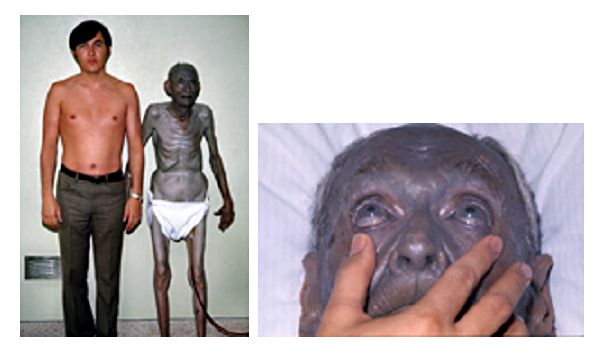 Cette image montre bien le contraste entre la couleur de peau d'une personne atteinte d'argyrie et celle d'une personne non touchée par cette maladie cutanée. Le seul responsable : l'argent. © Herbert Fred, Hendrik van Dijk, Wikipédia, cc by 2.0