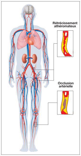 L'artérite concerne principalement les membres inférieurs. © prevention-cardio.fr