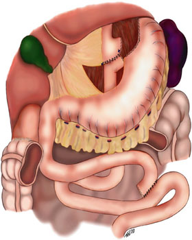La technique classique de bypass gastrique est celle de Roux-en-Y, mise au point par le chirurgien suisse César Roux. Au premier plan, on voit la plus grande partie de l'estomac et l'anse biliaire de l'intestin grêle déconnecté du système digestif. Un peu derrière, on voit la partie haute de l'estomac reliée par des agrafes au reste de l'intestin grêle.&nbsp;© Ethicon Endosurgery Inc., Wikipédia, DP