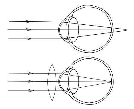 L'hypermétropie est schématisée dans le premier cas. La lumière qui arrive contre la cornée et le cristallin n'est pas suffisamment focalisée vers la rétine. Ainsi, les rayons convergent en un point situé derrière elle. Le deuxième schéma montre la situation normale.