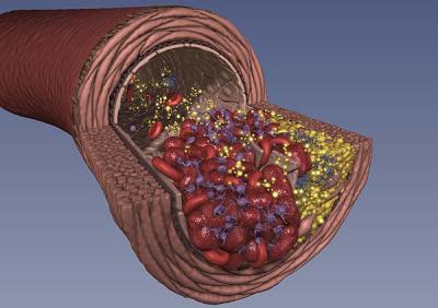 La thrombose peut être veineuse ou artérielle. © DR