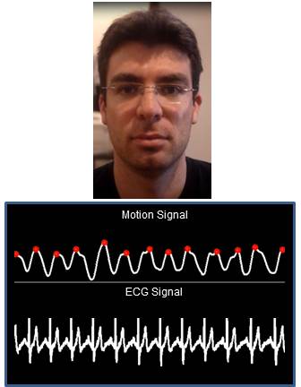 Cette capture issue de l’analyse vidéo compare le relevé obtenu par l’algorithme à partir des mouvements de la tête (motion signal) avec l’électrocardiogramme (ECG signal). Les chercheurs du MIT admettent que leur technique présente une marge d’erreur de quelques battements par minute. © MIT, CSAIL