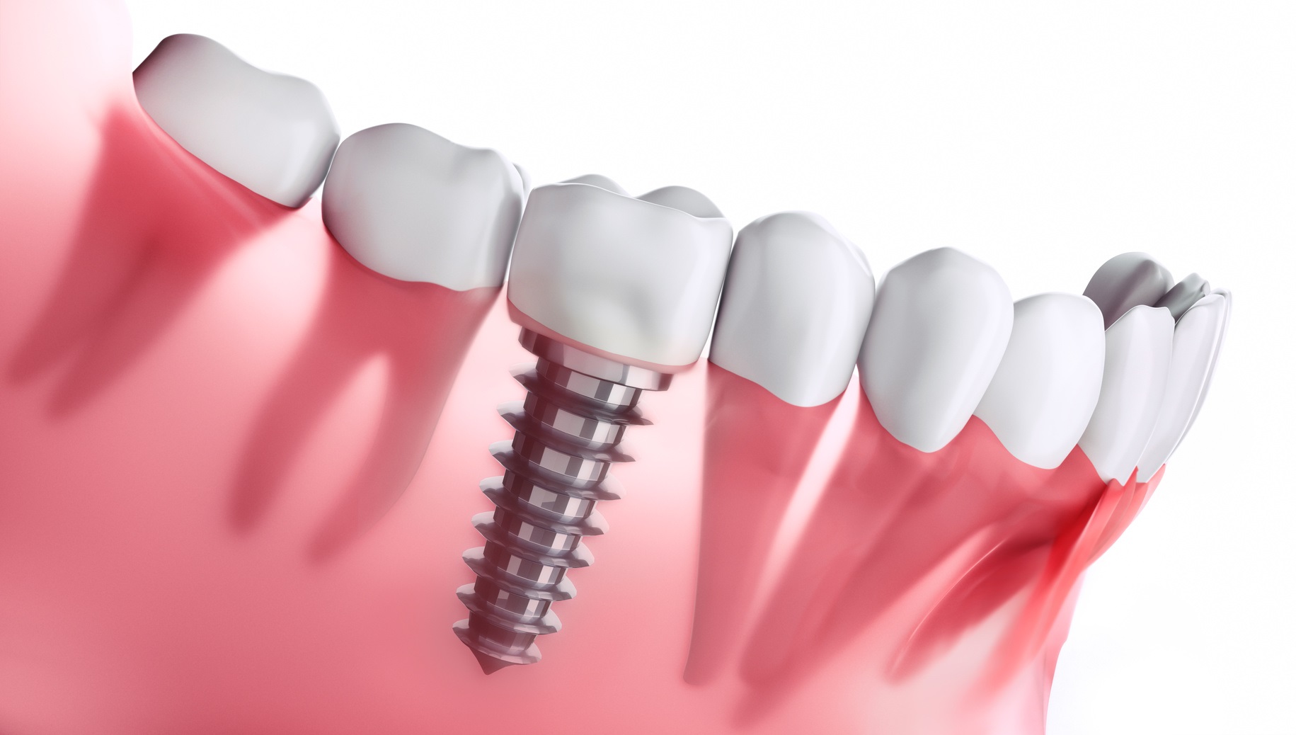 L’implant dentaire comprend une vis biocompatible pour fixer la couronne dans la gencive. © peterschreiber.media, Fotolia