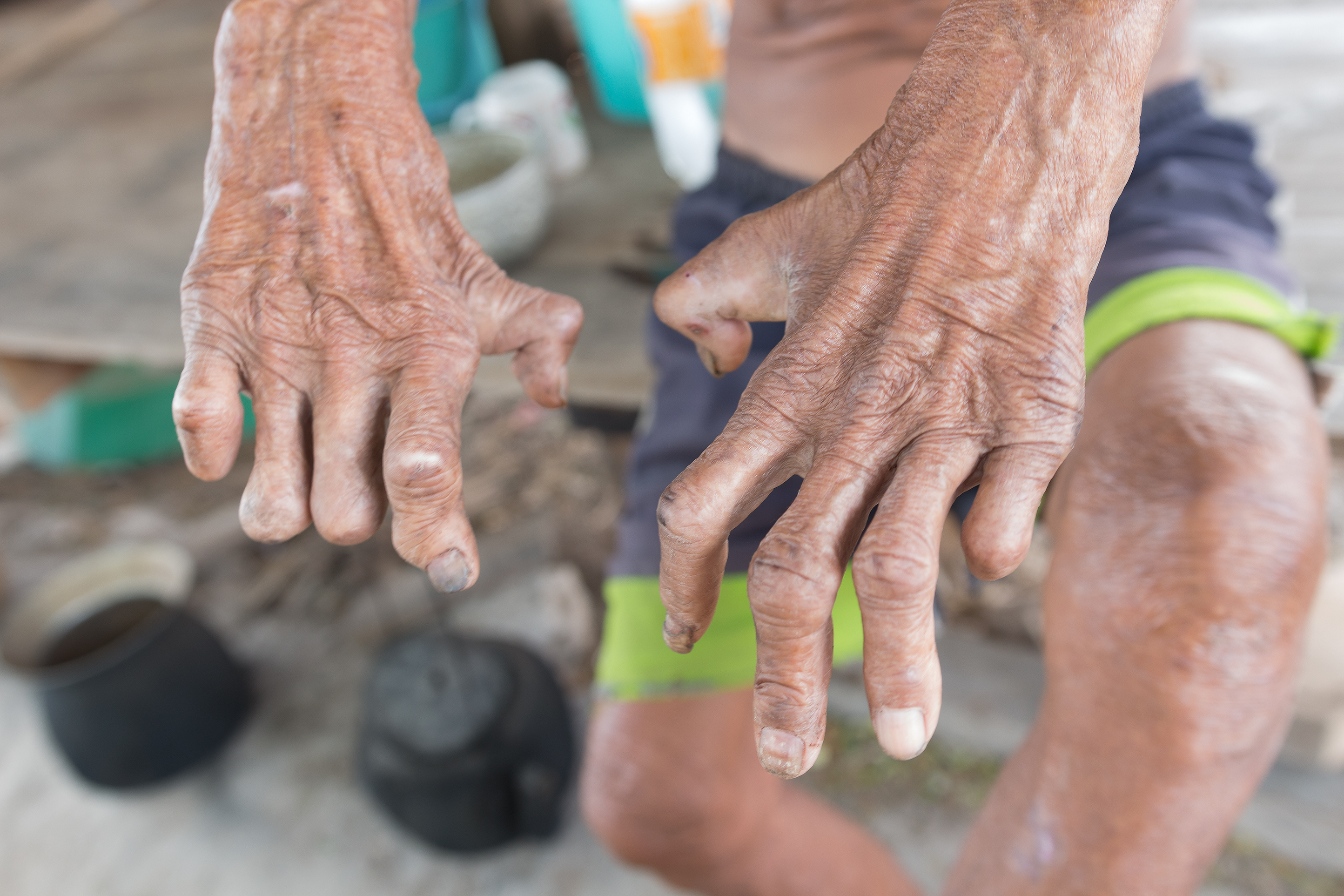 Les mains en griffe sont typiques d'une atteinte neurologique des membres causée par la lèpre. © r frank29052515, Adobe Stock