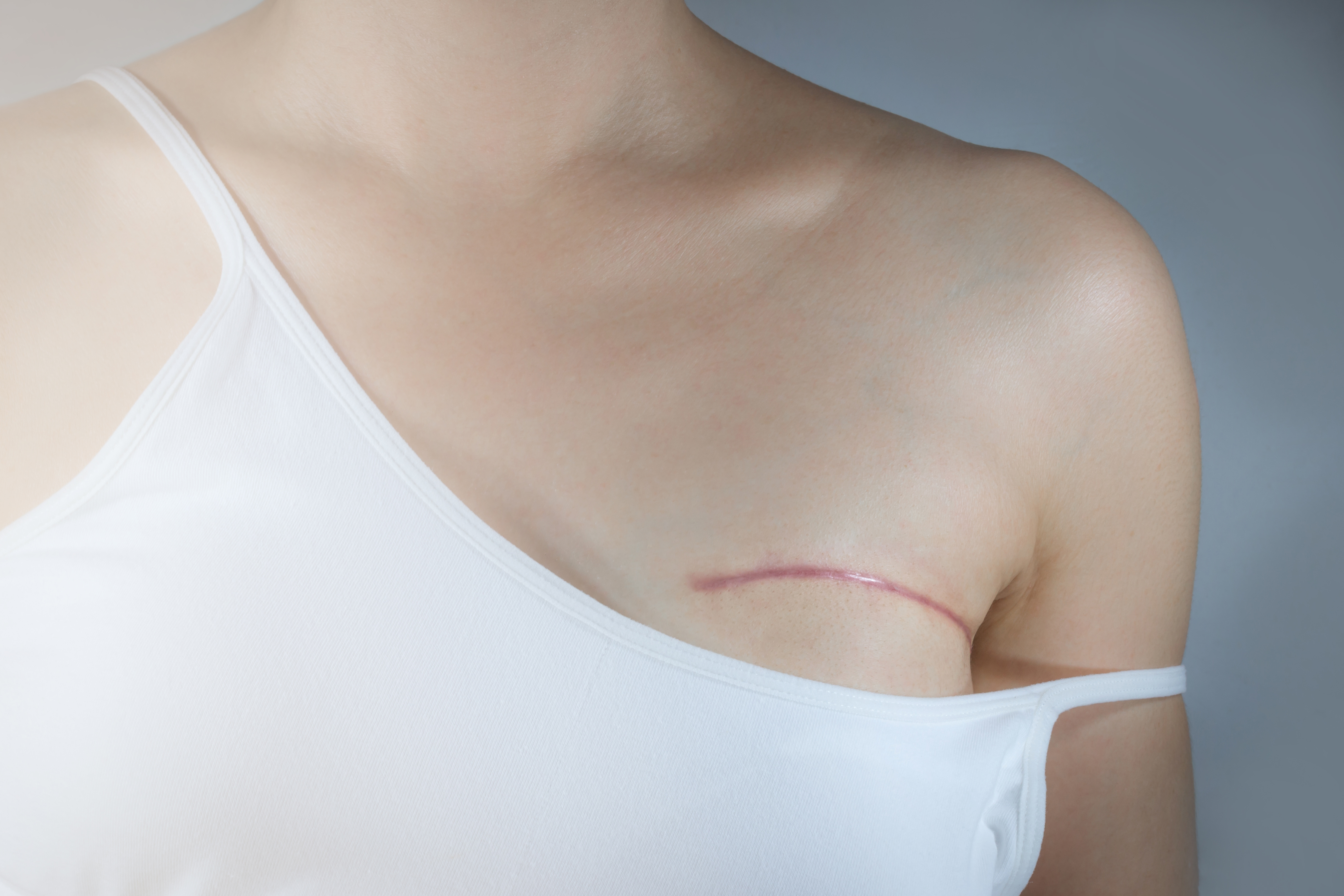Après une mastectomie, 30 % des femmes réalisent une reconstruction mammaire. © Pradit, Adobe Stock
