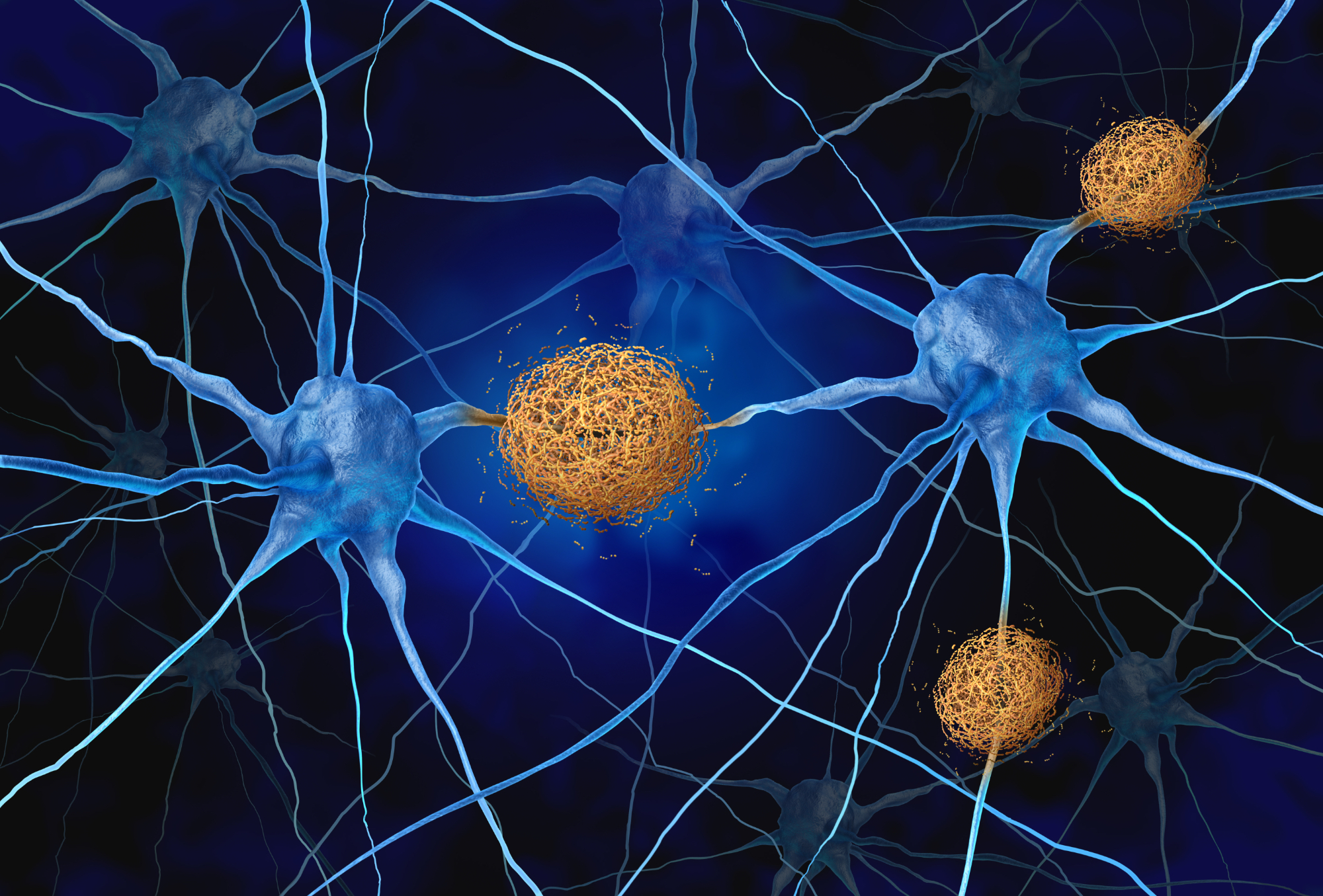 Les plaques amyloïdes, ces amas de protéines qui s’accumulent dans le cerveau, sont responsables de la dégénérescence des neurones et des troubles de la mémoire caractéristiques de la maladie d’Alzheimer. Mais une étude américaine du MUSC Hollings Cancer Center révèle que cette même protéine pourrait renforcer le système immunitaire et aider à lutter contre le cancer. © freshidea, Adobe Stock