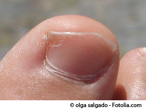 Les joggeurs doivent faire attention aux microtraumatismes répétés, pouvant engendrer des ongles incarnés. © Olga Salgado-Fotolia