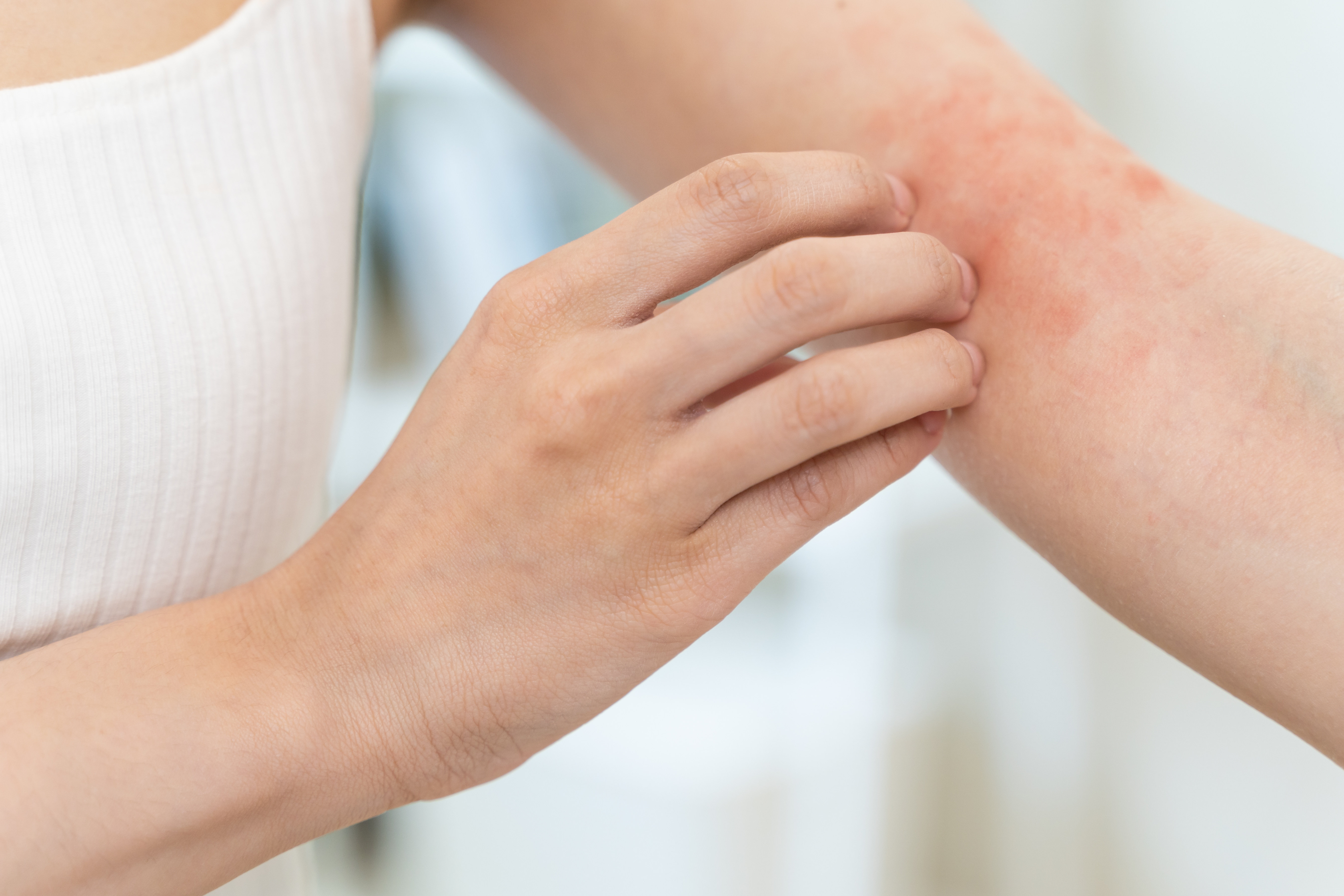 Reconnaître une réaction allergique cutanée est essentiel pour prendre les mesures appropriées et soulager les symptômes. © Pormezz, Adobe Stock